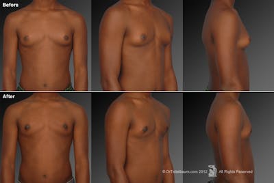 Chest (Gynecomastia) Before & After Gallery - Patient 106041450 - Image 1