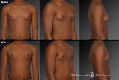 Chest (Gynecomastia) Before & After Gallery - Patient 106041450 - Image 1