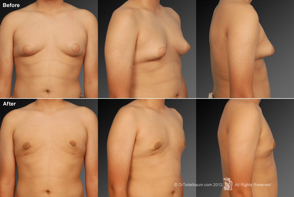 Chest (Gynecomastia) Before & After Gallery - Patient 106041451 - Image 1