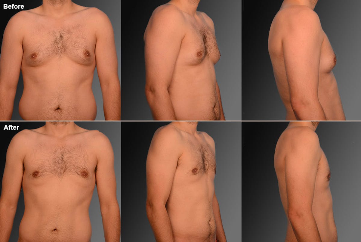 Chest (Gynecomastia) Before & After Gallery - Patient 106041452 - Image 1