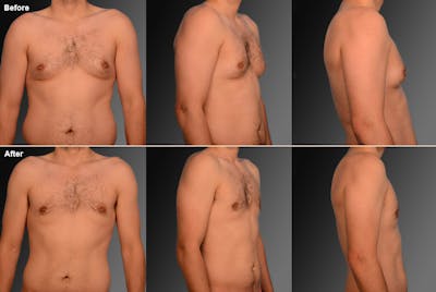 Chest (Gynecomastia) Before & After Gallery - Patient 106041452 - Image 1