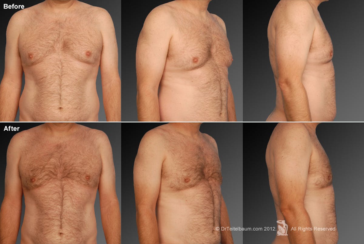 Chest (Gynecomastia) Before & After Gallery - Patient 106041453 - Image 1