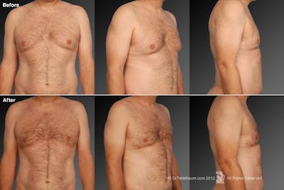 Chest (Gynecomastia) Before & After Gallery - Patient 106041453 - Image 1