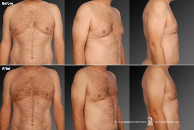 Chest (Gynecomastia) Before & After Gallery - Patient 106041453 - Image 1