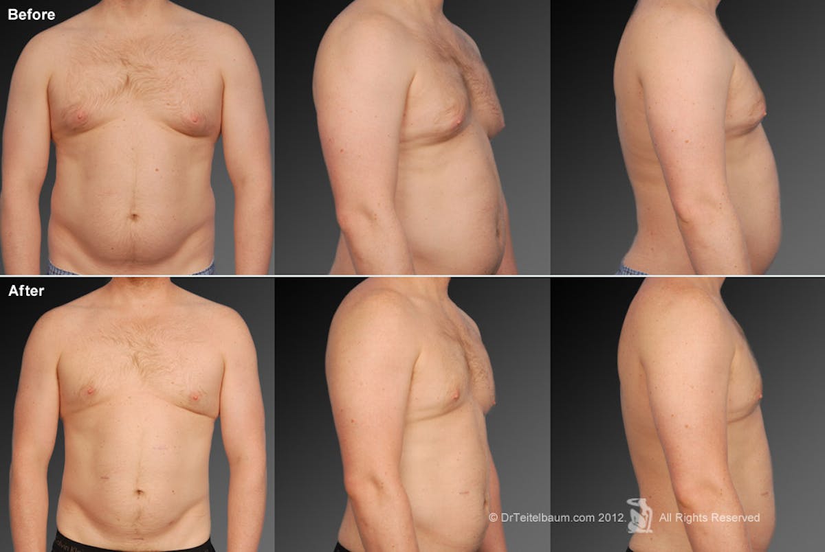 Chest (Gynecomastia) Before & After Gallery - Patient 106041456 - Image 1