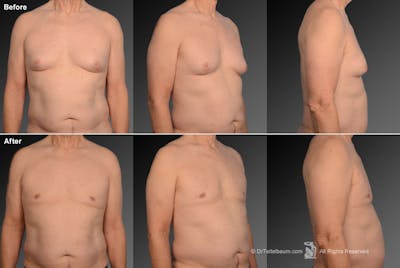 Chest (Gynecomastia) Before & After Gallery - Patient 106041458 - Image 1