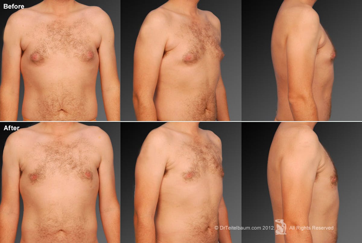 Chest (Gynecomastia) Before & After Gallery - Patient 106041459 - Image 1