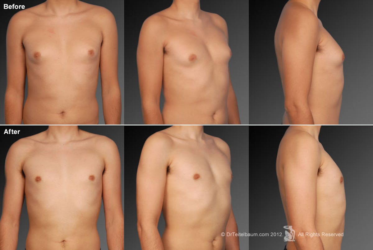 Chest (Gynecomastia) Before & After Gallery - Patient 106041460 - Image 1