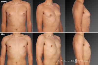 Chest (Gynecomastia) Before & After Gallery - Patient 106041460 - Image 1