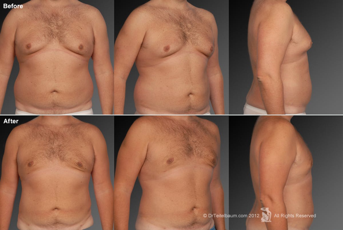 Chest (Gynecomastia) Before & After Gallery - Patient 106041462 - Image 1