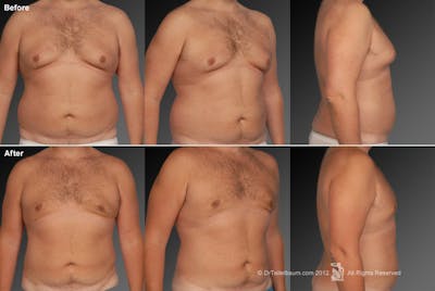 Chest (Gynecomastia) Before & After Gallery - Patient 106041462 - Image 1