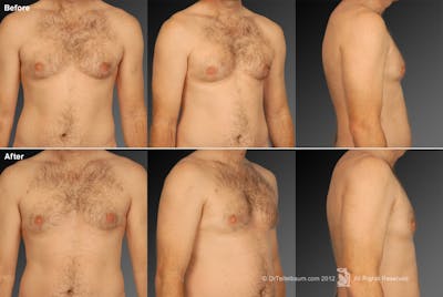 Chest (Gynecomastia) Before & After Gallery - Patient 106041463 - Image 1