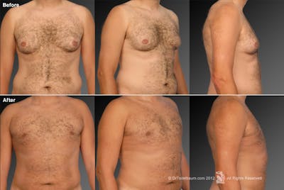 Chest (Gynecomastia) Before & After Gallery - Patient 106041464 - Image 1