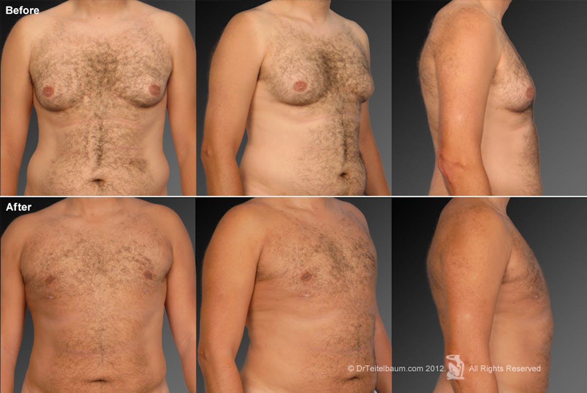 Chest (Gynecomastia) Before & After Gallery - Patient 106041464 - Image 1