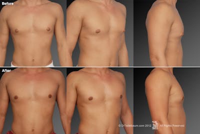 Chest (Gynecomastia) Before & After Gallery - Patient 106041465 - Image 1