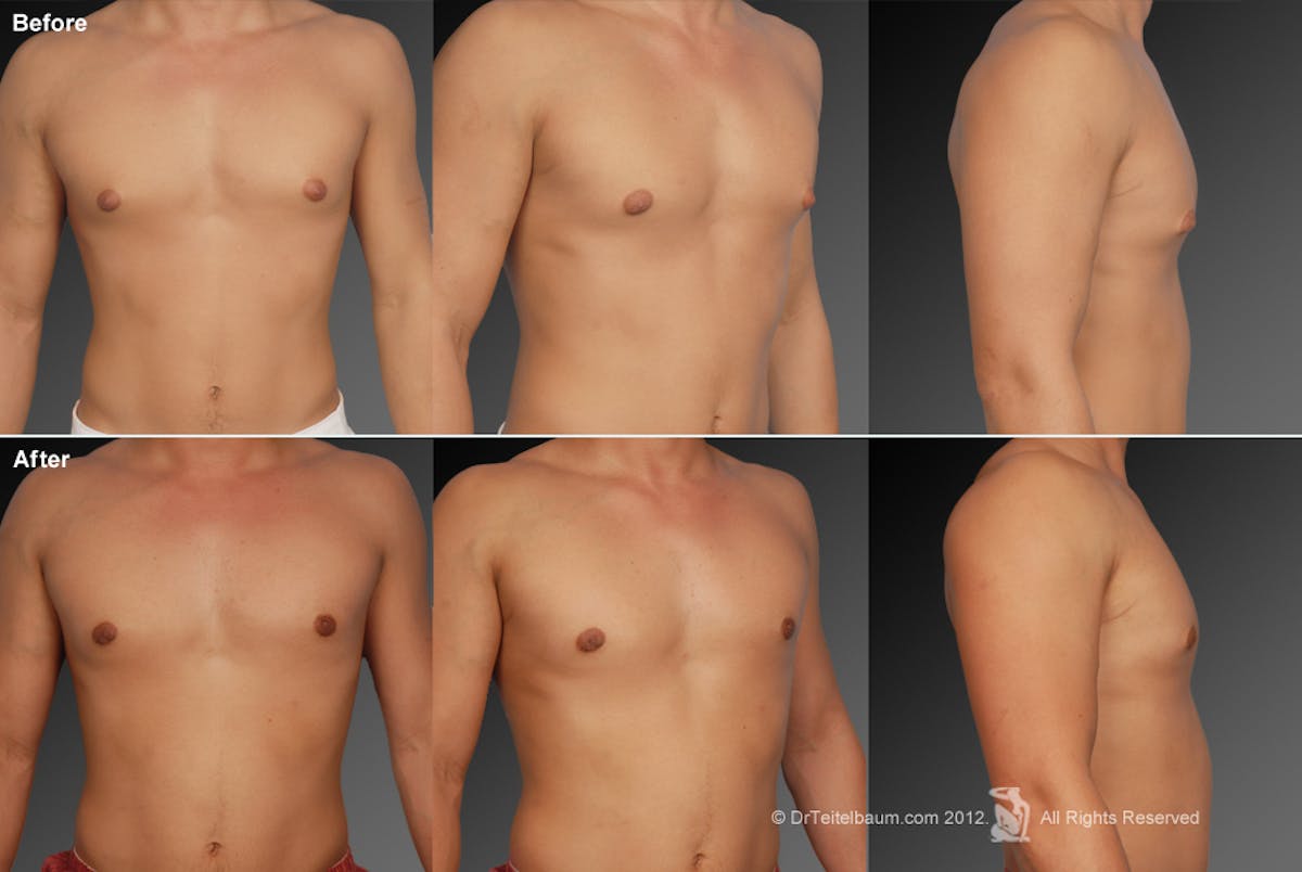 Chest (Gynecomastia) Before & After Gallery - Patient 106041465 - Image 1