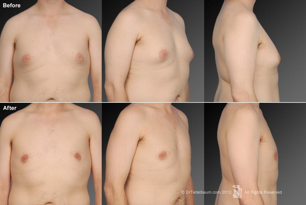 Chest (Gynecomastia) Before & After Gallery - Patient 106041467 - Image 1