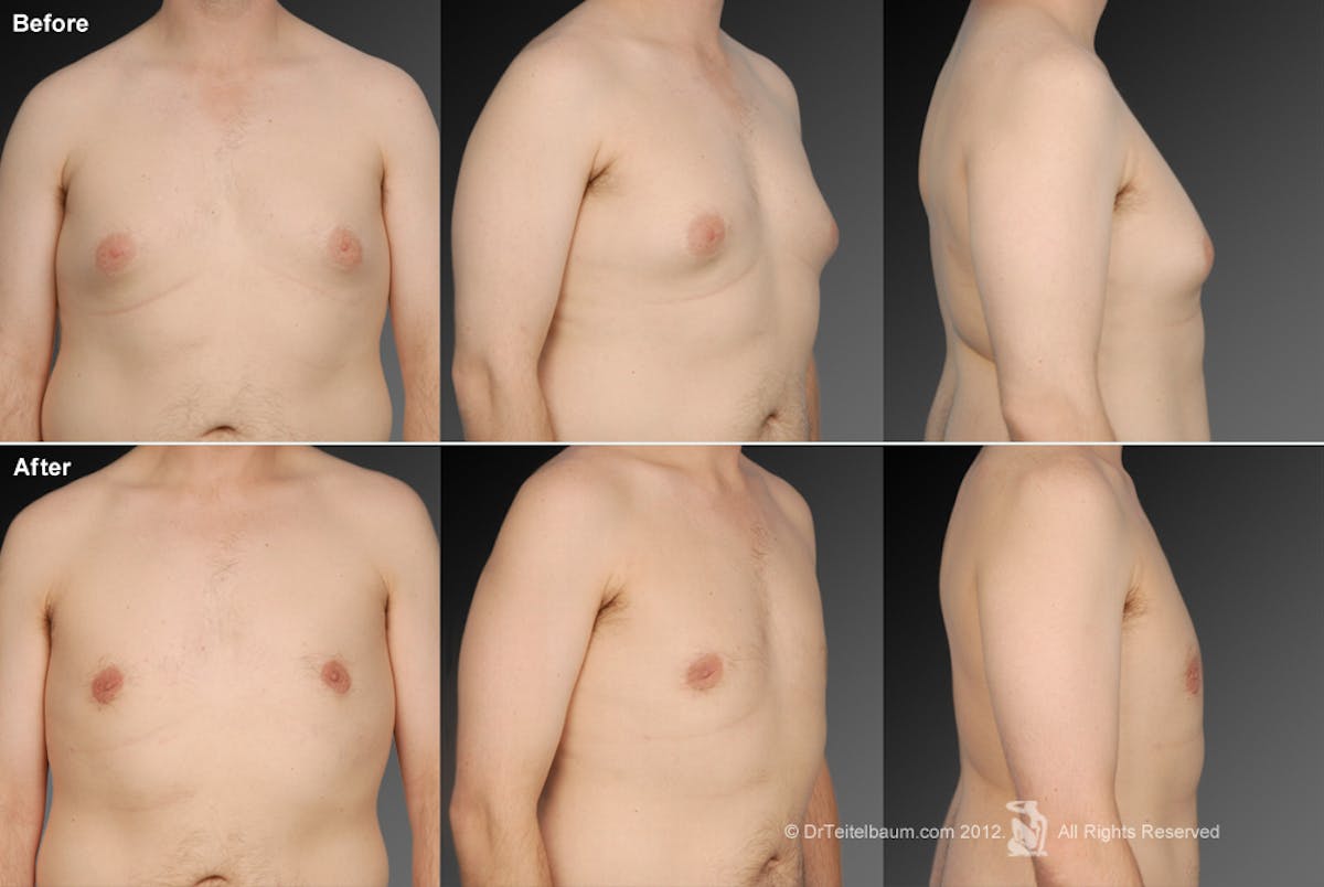 Chest (Gynecomastia) Before & After Gallery - Patient 106041467 - Image 1