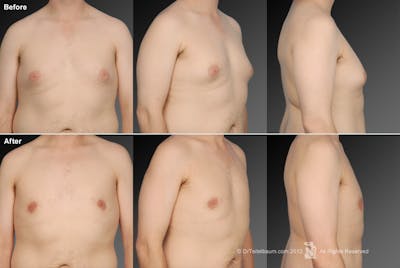 Chest (Gynecomastia) Before & After Gallery - Patient 106041467 - Image 1