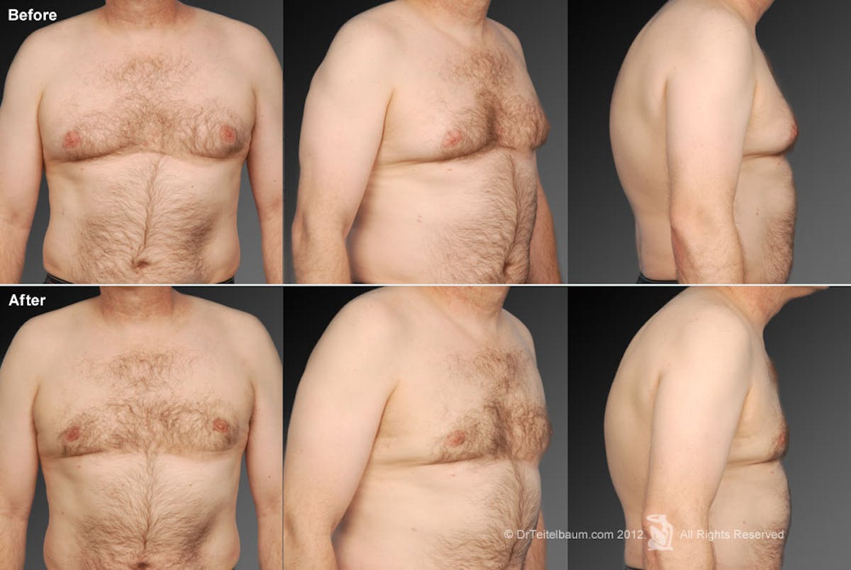 Chest (Gynecomastia) Before & After Gallery - Patient 106041468 - Image 1