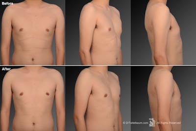 Chest (Gynecomastia) Before & After Gallery - Patient 106041472 - Image 1