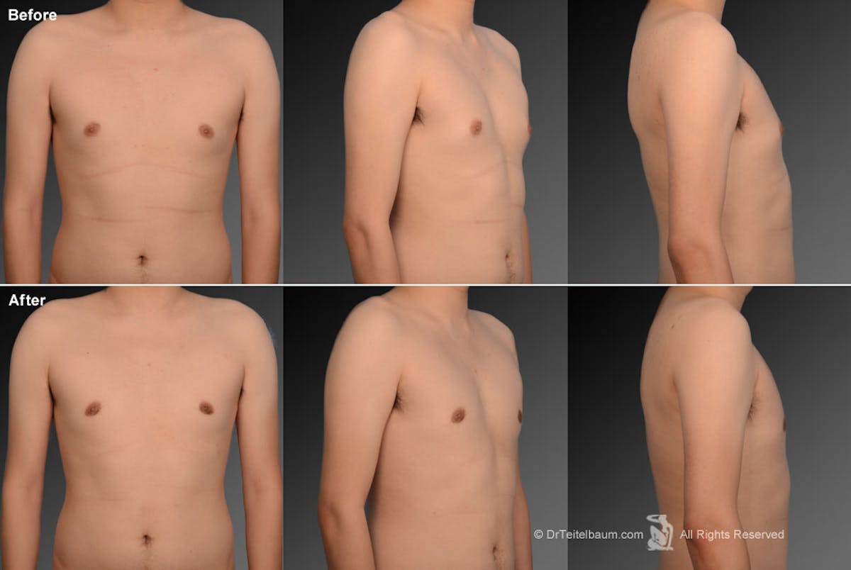 Chest (Gynecomastia) Before & After Gallery - Patient 106041472 - Image 1