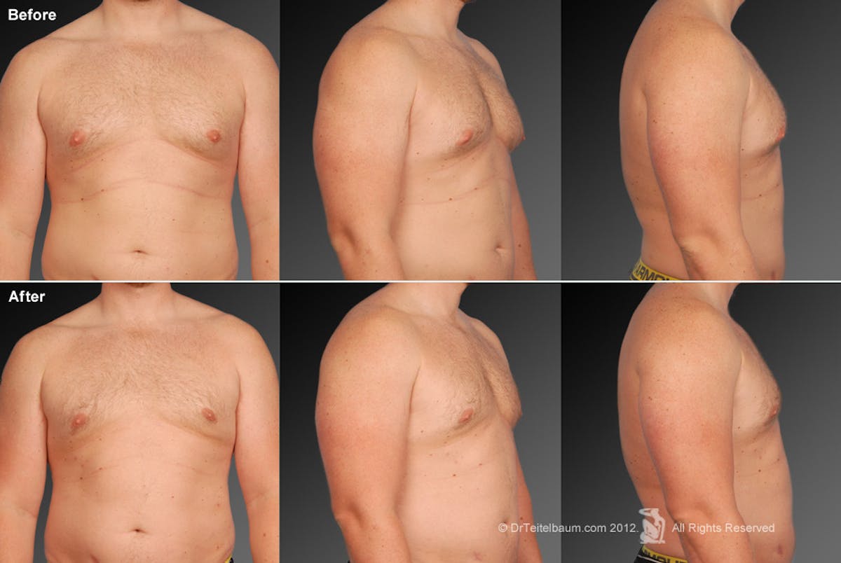 Chest (Gynecomastia) Before & After Gallery - Patient 106041473 - Image 1