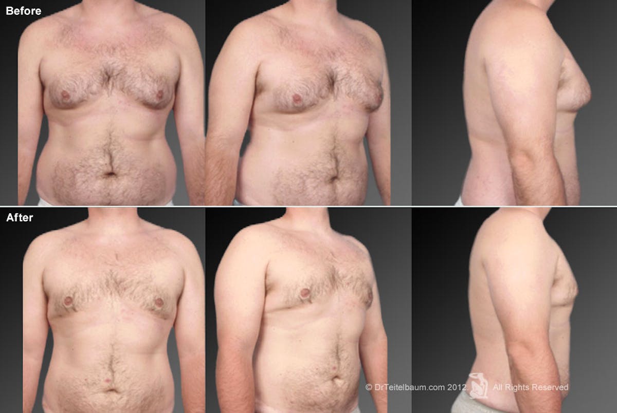 Chest (Gynecomastia) Before & After Gallery - Patient 106041474 - Image 1