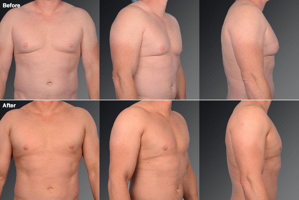 Chest (Gynecomastia) Before & After Gallery - Patient 106041475 - Image 1