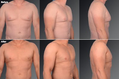 Chest (Gynecomastia) Before & After Gallery - Patient 106041475 - Image 1