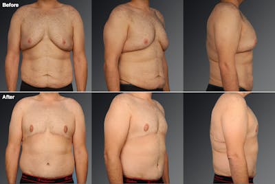 Chest (Gynecomastia) Before & After Gallery - Patient 106041476 - Image 1
