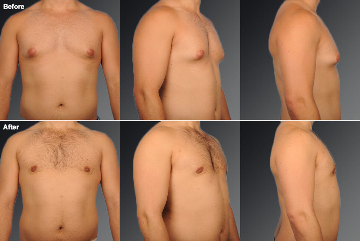 Chest (Gynecomastia) Before & After Gallery - Patient 106041477 - Image 1