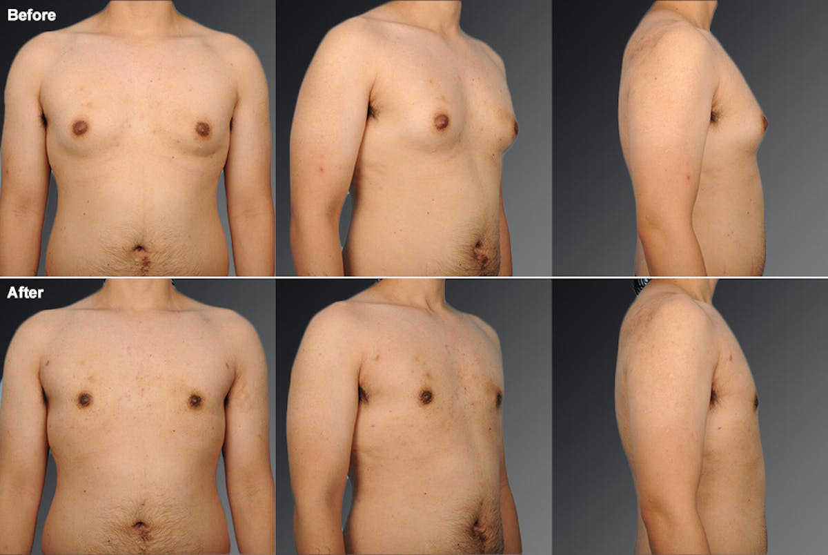 Chest (Gynecomastia) Before & After Gallery - Patient 106041478 - Image 1