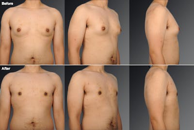 Chest (Gynecomastia) Before & After Gallery - Patient 106041478 - Image 1