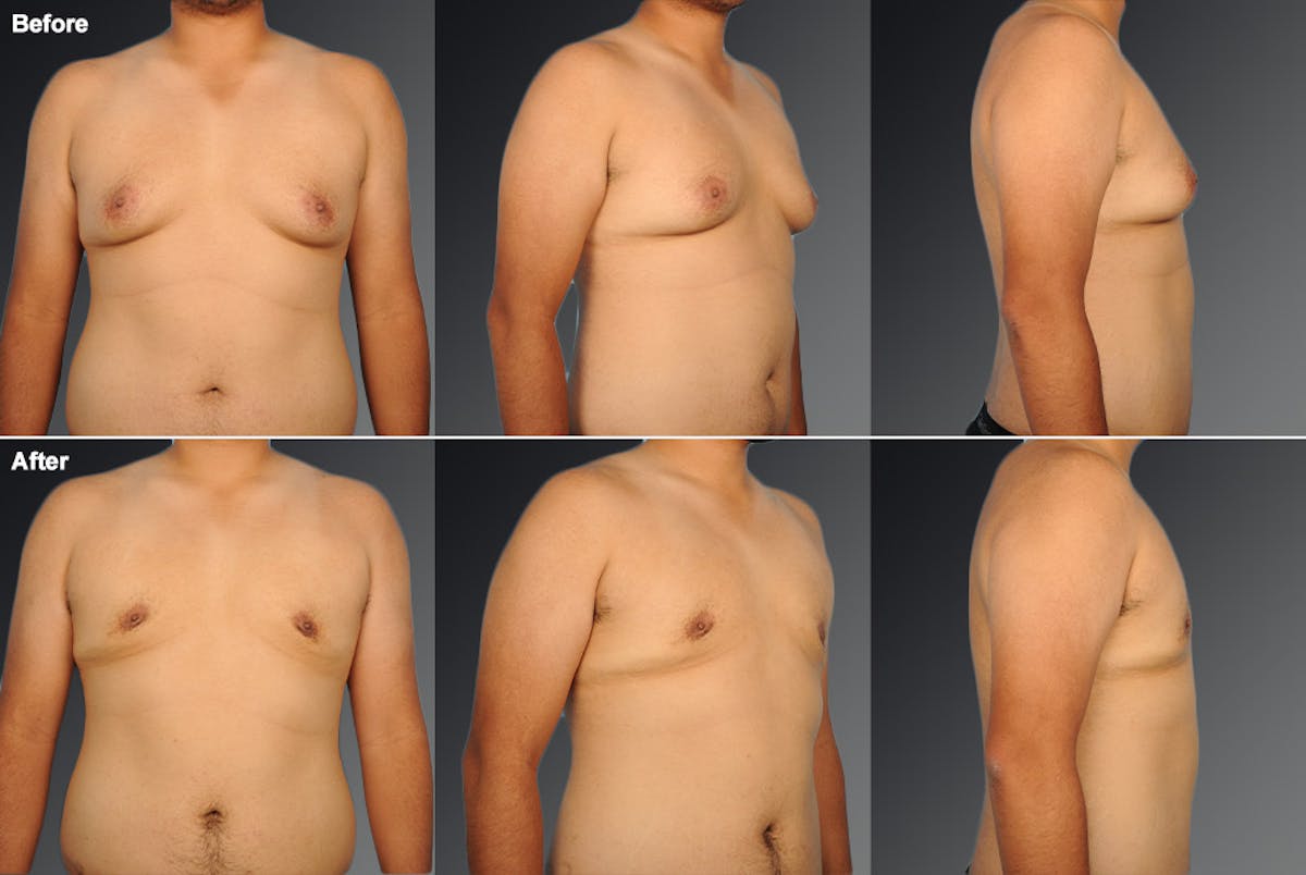 Chest (Gynecomastia) Before & After Gallery - Patient 106041479 - Image 1
