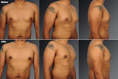 Chest (Gynecomastia) Before & After Gallery - Patient 106041480 - Image 1