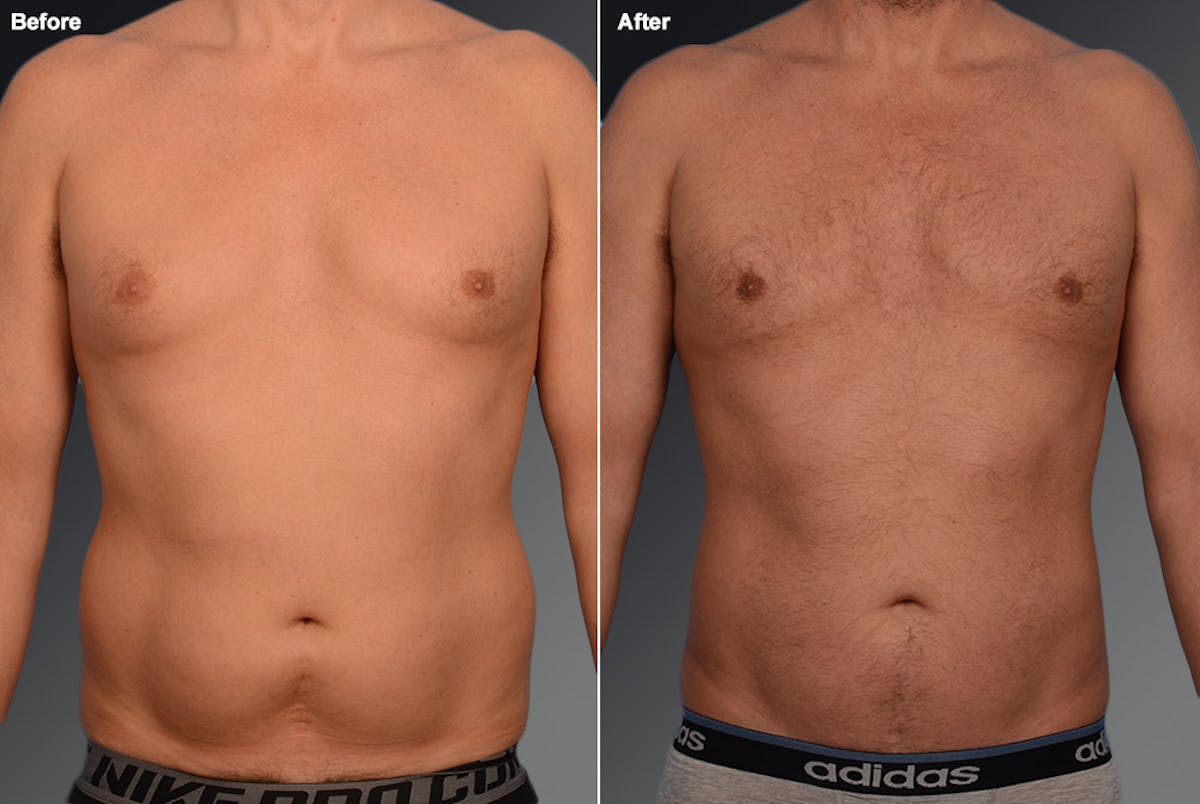 Chest (Gynecomastia) Before & After Gallery - Patient 106041481 - Image 1