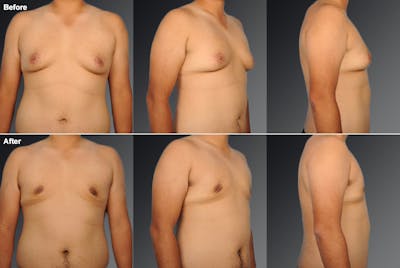 Chest (Gynecomastia) Before & After Gallery - Patient 106041484 - Image 1