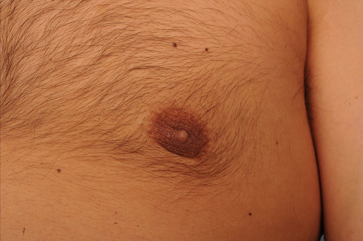 Chest (Gynecomastia) Before & After Gallery - Patient 106041486 - Image 1