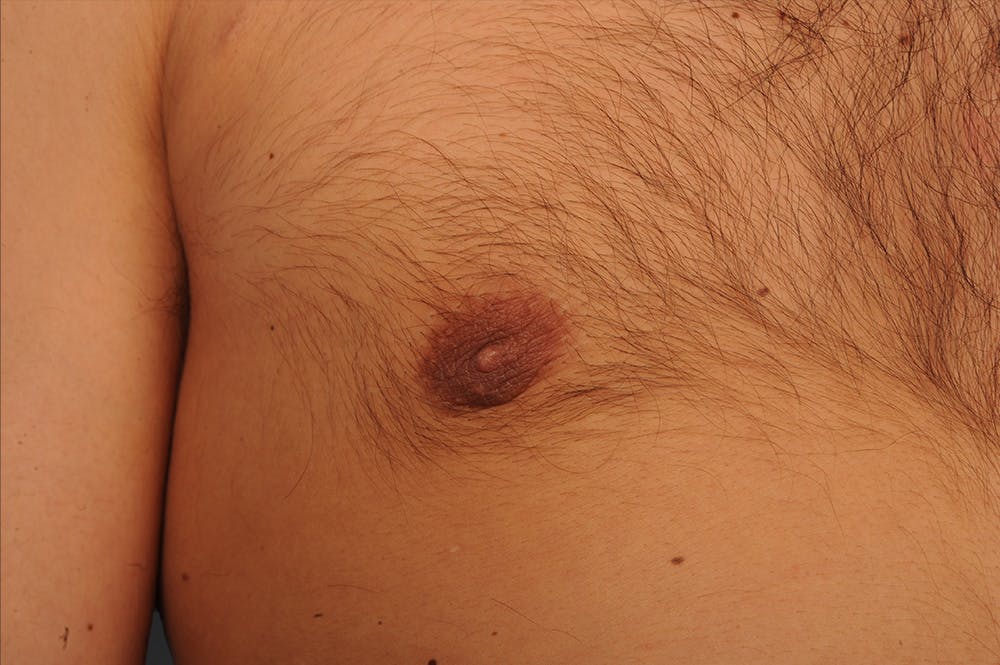 Chest (Gynecomastia) Before & After Gallery - Patient 106041487 - Image 1