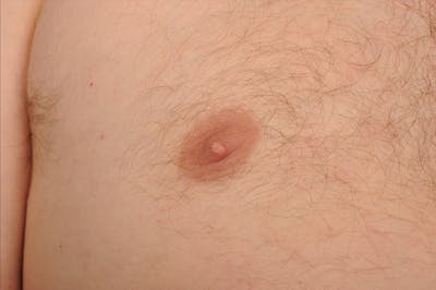 Chest (Gynecomastia) Before & After Gallery - Patient 106041488 - Image 1