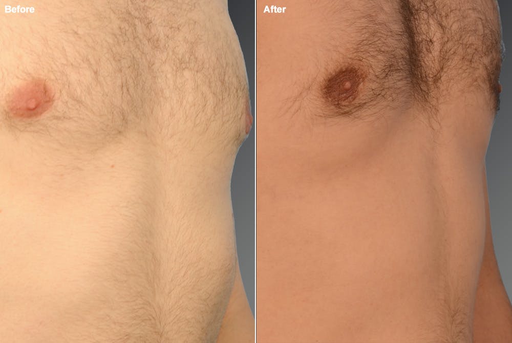 Chest (Gynecomastia) Before & After Gallery - Patient 106041491 - Image 1