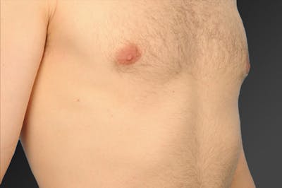 Chest (Gynecomastia) Before & After Gallery - Patient 106041492 - Image 1