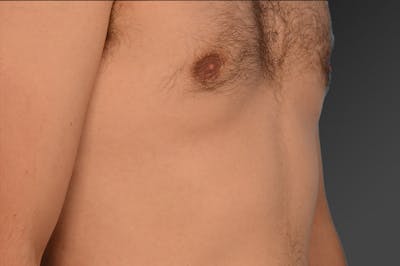 Chest (Gynecomastia) Before & After Gallery - Patient 106041493 - Image 1