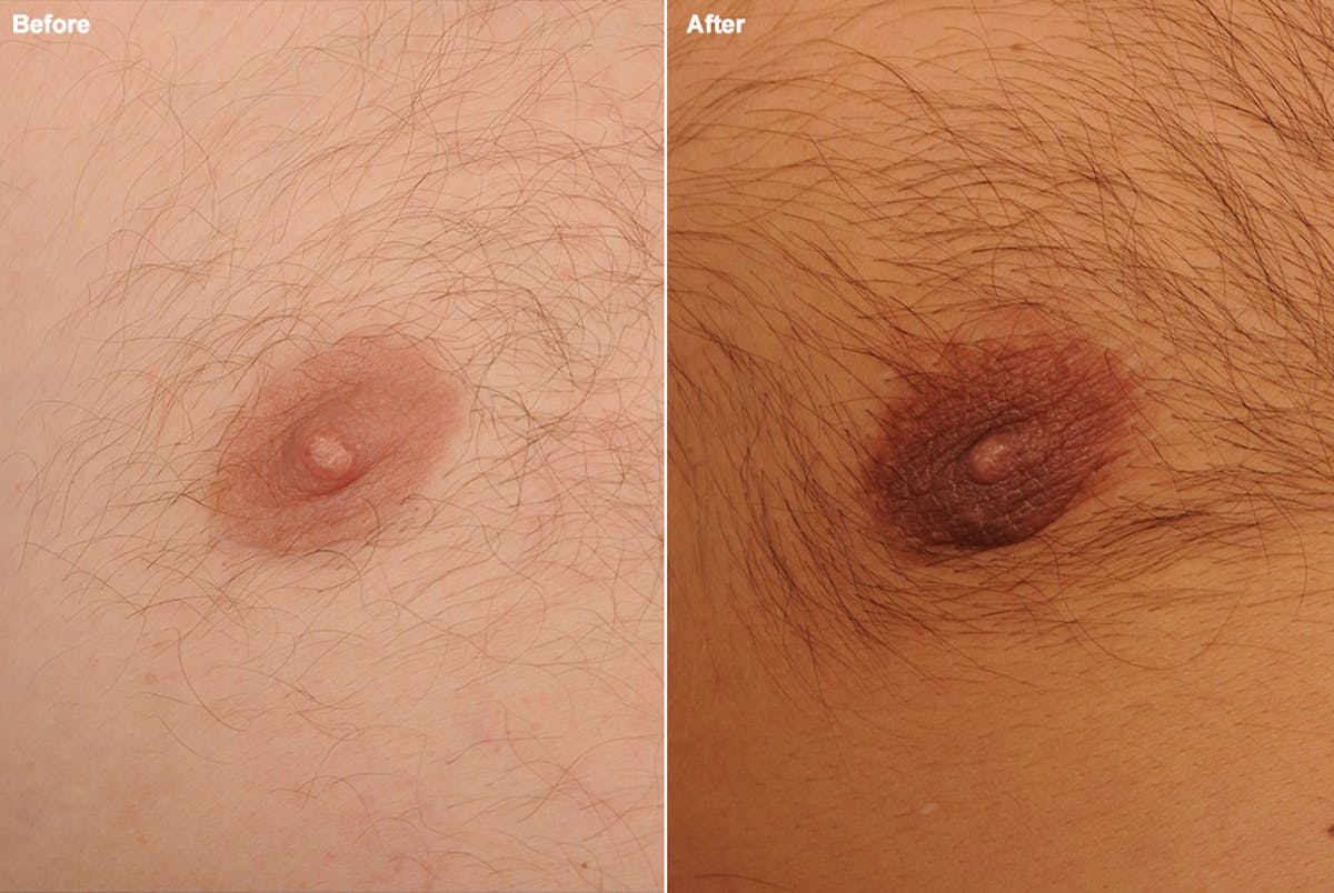 Chest (Gynecomastia) Before & After Gallery - Patient 106041494 - Image 1
