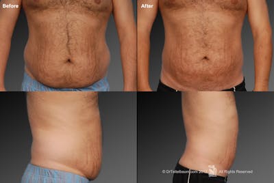 Liposuction Before & After Gallery - Patient 106041495 - Image 1