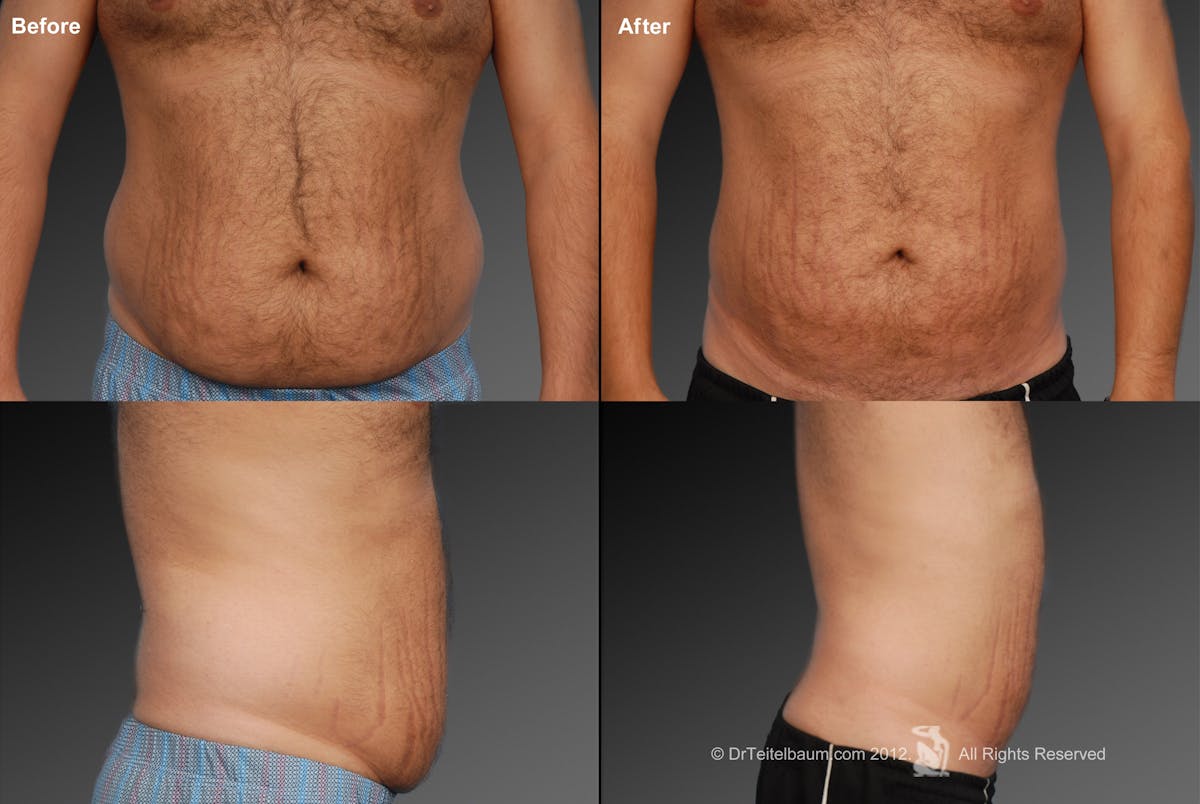 Liposuction Before & After Gallery - Patient 106041495 - Image 1