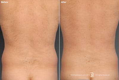 Liposuction Before & After Gallery - Patient 106041496 - Image 1