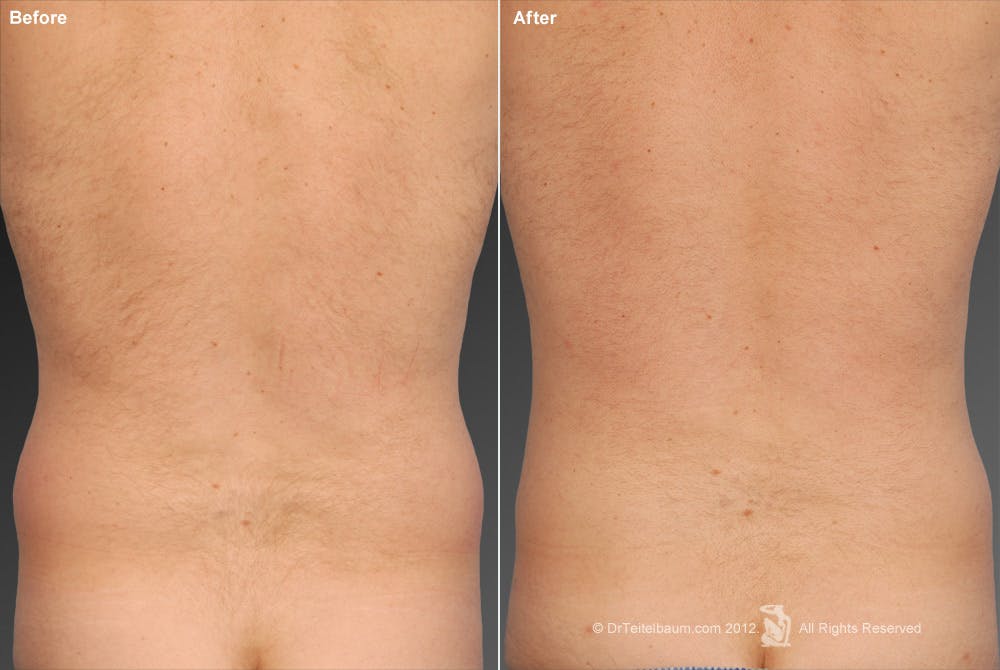 Liposuction Before & After Gallery - Patient 106041496 - Image 1