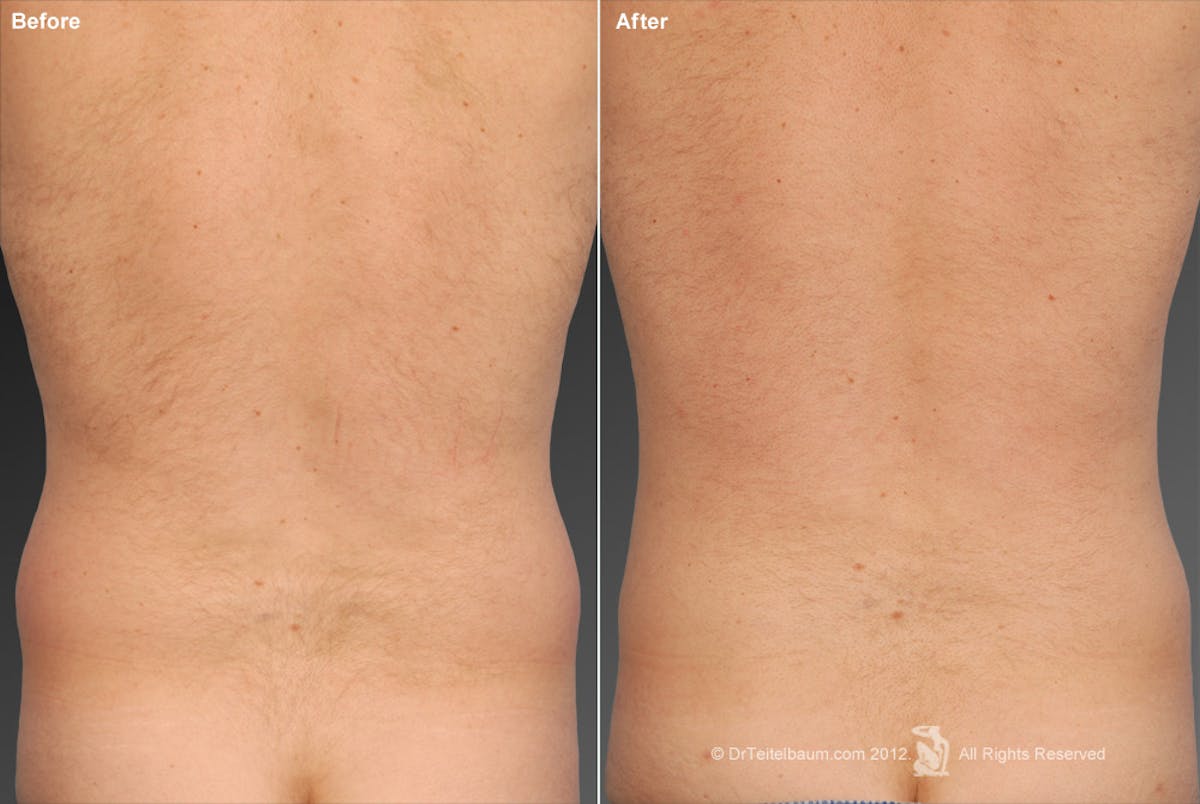 Liposuction Before & After Gallery - Patient 106041496 - Image 1